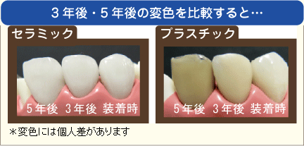 ３年後・５年後の変色の比較